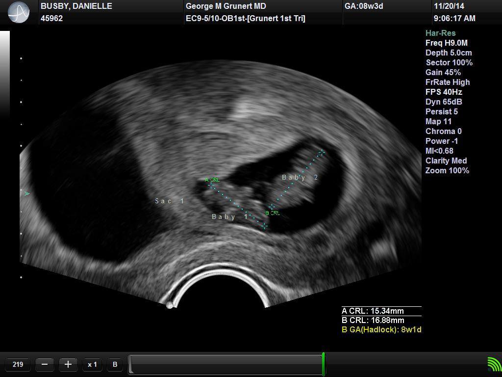 First Ultrasound of the Identical Twins
