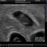 Ultrasound Sac 2