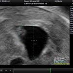 Ultrasound Sac 3