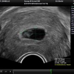 Ultrasound Sac 4