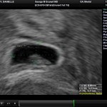 Ultrasound Sac 1